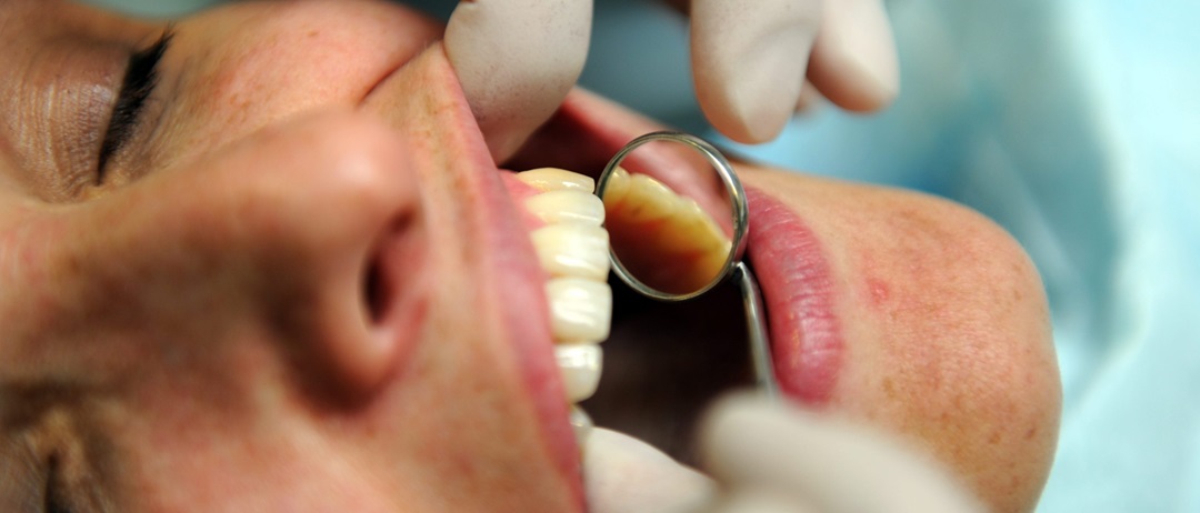 Wysokiej mocy rezonans magnetyczny powoduje wyciek rtęci z dentystycznych plomb